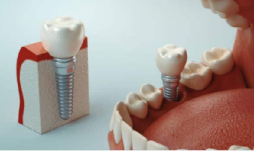 Dental Implants Jpg Img
