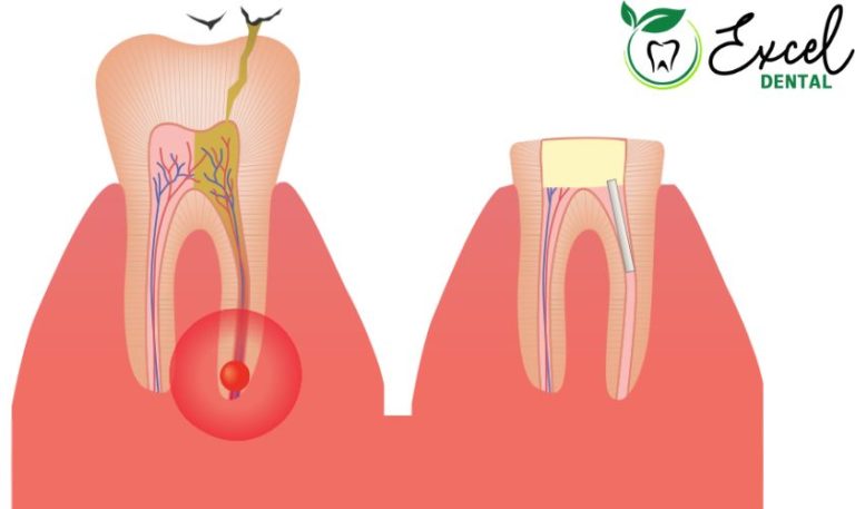 know-the-signs-of-a-root-canal-infection