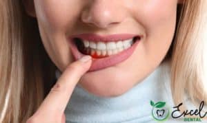 Five-Ways-To-Avoid-Gum-Disease