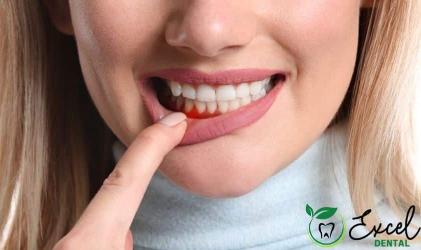 Five-Ways-To-Avoid-Gum-Disease
