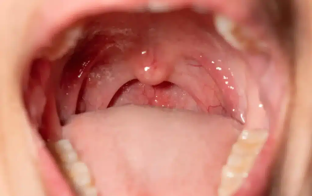 Indications of a Tooth Infection Extending to the Body