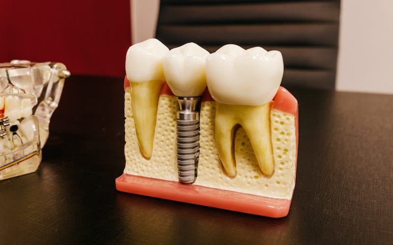 Dental Implants - Excel dental, TX