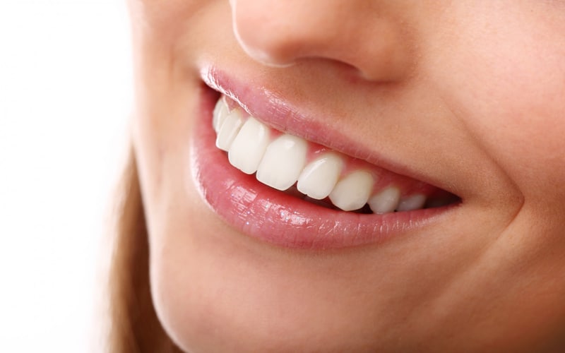 Teeth Whitening Solutions - Missouri City Excel Dental, TX