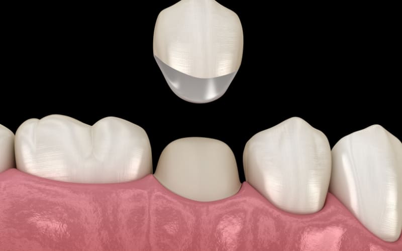 Dental Crown - Missouri City Dentist - Excel Dental, TX
