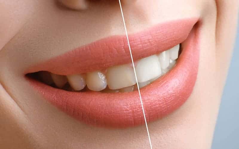 Teeth Whitening - Missouri City Dentist - Excel Dental, TX