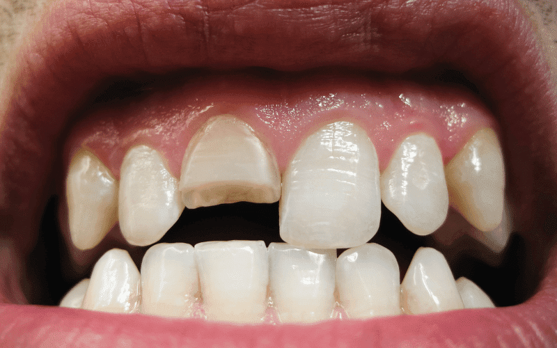 Broken Tooth - Excel Dental Missouri City