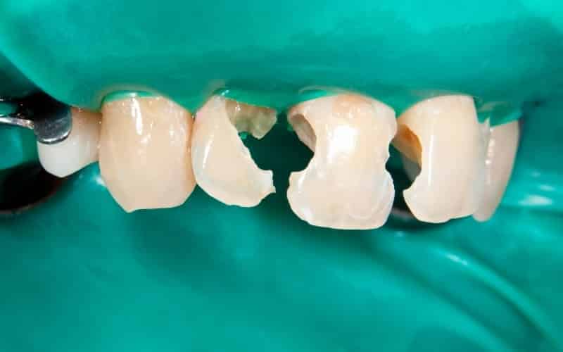Cracked Teeth - Missouri City Dentist - Excel Dental, TX