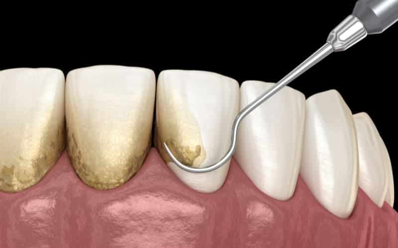 Teeth Cleaning - Missouri City Dentist - Excel Dental, TX