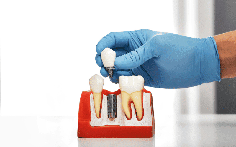 Dental Implants - Missouri City Excel Dental