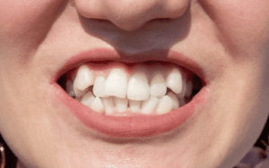 straighten your teeth without braces