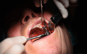 right age for tooth extraction