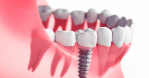 Dental Implants: A Way to Replace Lost Teeth