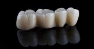 Dental Crowns Explained: Restoring Your Smile’s Strength And Beauty