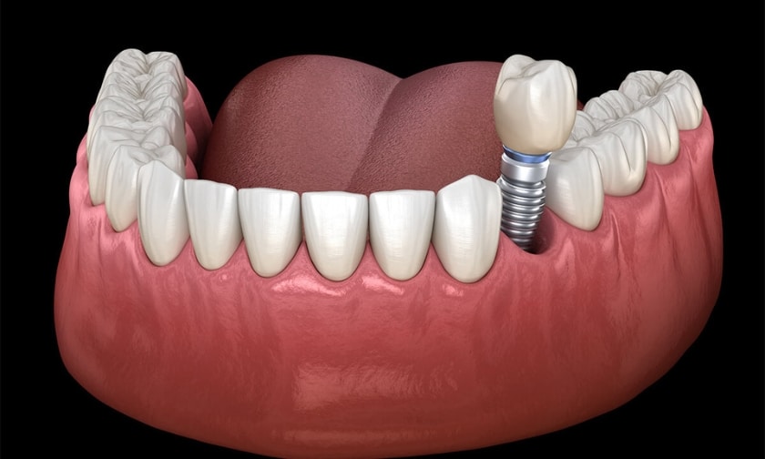 How Your Smile Benefits From Dental Implants