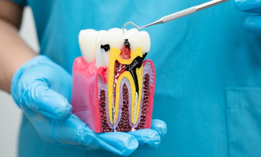 The Long-Term Benefits Of Choosing Root Canal Therapy